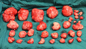 fibroids after removal